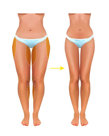 Surgical lines on beautiful womans body. vectorのイラスト素材
