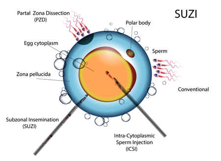 types of artificial fertilization of the egg by sperm ECO und ICSI SUZIのイラスト素材