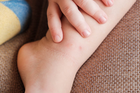Toddler touches her leg after being bitten by mosquito or bedbug, suffering from allergic reaction and swelling, experiencing pain, sits on bed at home. Skin reaction to blood-sucking insects. allergyの写真素材
