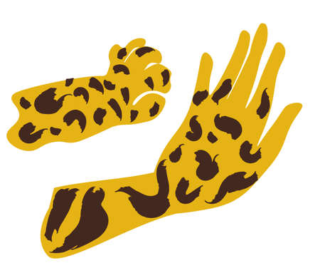 the hand of a person with vitiligo. World vitiligo day. Vector illustration isolated on white backgroundのイラスト素材