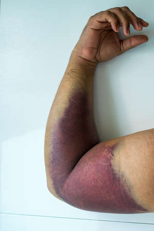 Bicep tear or strain, tendon injuries on a muscular man hand. Trauman or trauma injury. Health and medical and fitness concept.の写真素材