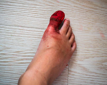 Big toe accident resulting in serious injury from heavy objects Broken toe nail with many bleeding...