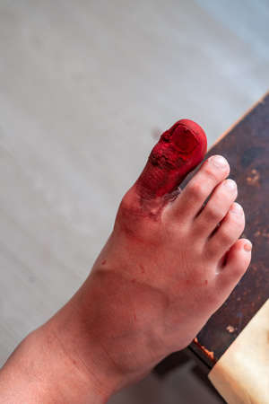 Big toe accident resulting in serious injury from heavy objects Broken toe nail with many bleeding...