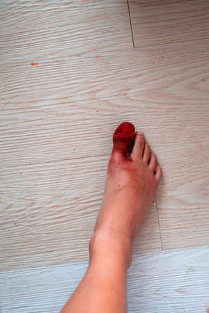 Big toe accident resulting in serious injury from heavy objects Broken toe nail with many bleeding...