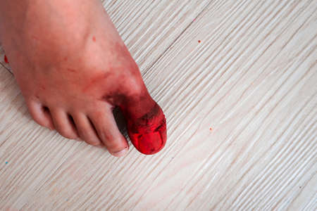 Big toe accident resulting in serious injury from heavy objects Broken toe nail with many bleeding wounds.の写真素材