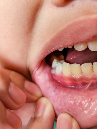 Kid's gum inflammation. red bleeding gums with bum. Close up. Dentistry, dental care.の写真素材