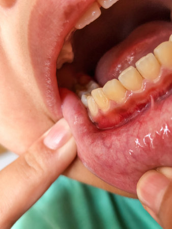 Kid's gum inflammation. red bleeding gums with bum. Close up. Dentistry, dental care.の写真素材
