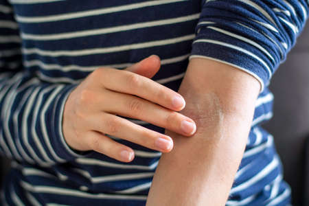 Close up female hands applying ointment on crook of arm / elbow. Apply a soothing cream in the treatment and hydration of the skin. Concept of skincare, eczema, allergy rash and other skin diseasesの写真素材