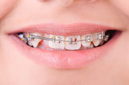 Mouth with brackets braces in medical conceptの写真素材