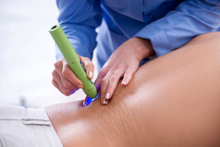 Patient in clinic undergoing laser scar removalの写真素材