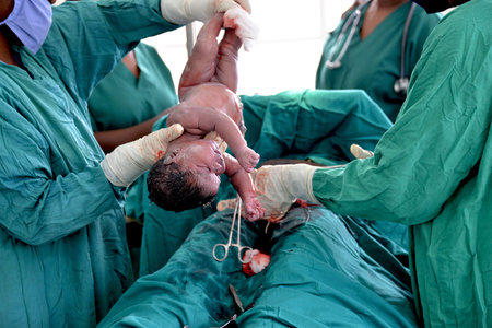 Caesarean Section  C-section 