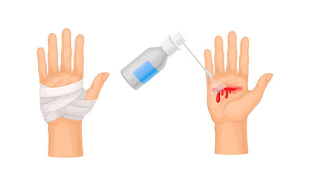 Skin burn injury treatment. First aid for thermal wound. Medicine for cure and bandaging vector illustrationのイラスト素材