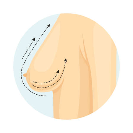 Cosmetic surgery on breast with dotted lines. Breast lift. Plastic surgery vector illustrationのイラスト素材