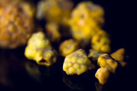 Gallstones,multiple cholesterol stone in gallbladder with cholecystitis. Gallbladder disease, stone...