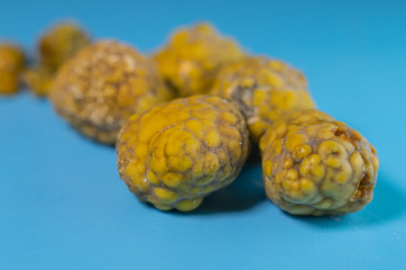 Gallstones,multiple cholesterol stone in gallbladder with cholecystitis. Gallbladder disease, stone formation. Cholecystectomy vs Laparoscopic Gallbladder Surgeryの写真素材