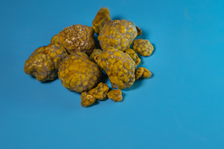 Gallstones,multiple cholesterol stone in gallbladder with cholecystitis. Gallbladder disease, stone formation. Cholecystectomy vs Laparoscopic Gallbladder Surgeryの写真素材
