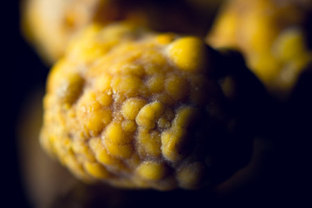 Gallstones, multiple cholesterol stone in gallbladder with cholecystitis. Gallbladder disease, stone...