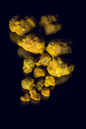 Gallstones multiple cholesterol stone in gallbladder with cholecystitis. Gallbladder disease, stone formation. Cholecystectomy vs Laparoscopic Gallbladder Surgeryの写真素材