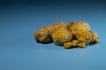 Gallstones, multiple cholesterol stone in gallbladder with cholecystitis. Gallbladder disease, stone formation. Cholecystectomy vs Laparoscopicの写真素材