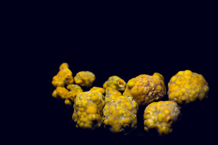Gallstones, multiple cholesterol stone in gallbladder with cholecystitis. Gallbladder disease, stone formation. Cholecystectomy vs Laparoscopicの写真素材