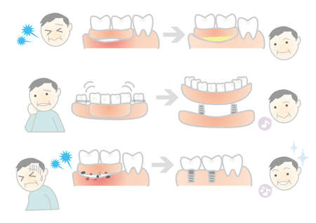 Dentures, bridges, implantsのイラスト素材