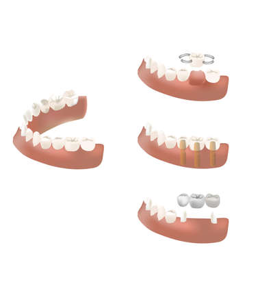 Tooth bridgesのイラスト素材