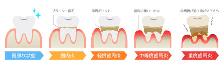 Illustration of periodontal disease / gingivitis progression and symptomsの写真素材