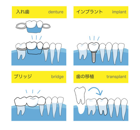 Treatment methods to replace lost teeth, such as implants, dentures, and tooth implants
Illustration ofのイラスト素材