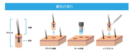 Flow of hair root transplantation and hair transplantationのイラスト素材