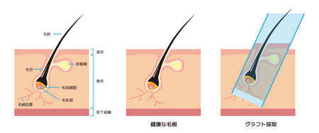 Cross-sectional view of hair root skin / normal hair matrix cells / graft collection / hair loss treatmentのイラスト素材