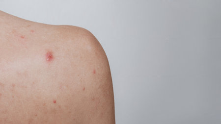 Close-up of the skin on the shoulder of a young girl with problems. Pimples, acne, pores, scars....