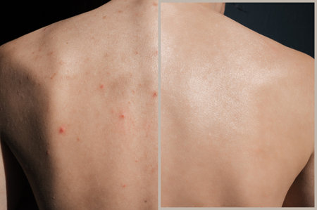 Close-up of the skin of a young girl with problems. Pimples, acne, pores, scars. Natural skin with and without filters. A place for your text.の写真素材