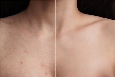 A close-up shot of the face and body of a young woman with skin problems - pimples, acne, enlarged pores.の写真素材
