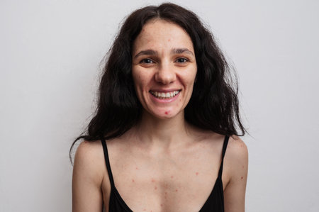 A large portrait of a young woman with skin problems - pimples, acne, enlarged pores.の写真素材