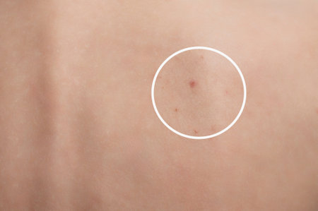 Close-up of the back skin of a woman with acne and other dermatological problems.の写真素材