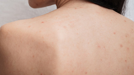A close-up of a panoramic shot of a womans skin prone to acne and other dermatological problems.の写真素材