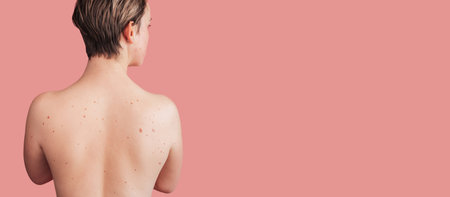 The back of a young woman with moles on the background. Without filters. Panoramic banner. A place for the text.の写真素材