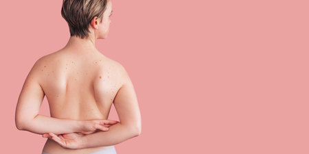 A womans back with numerous moles. The effect of the sun on the skin. Skin cancer. The panorama. A place for the text.の写真素材