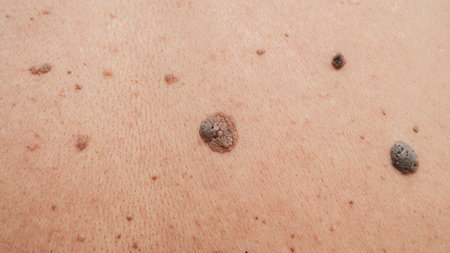 Moles and birthmarks on human skin close-up.の写真素材