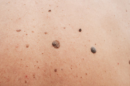 Human skin with freckles, aging spots, black and brown moles and warts, wrinklesの写真素材