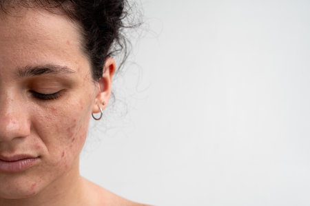 Close-up skin texture with red pimples, irritation and clogged pores, which indicates dermatological problems with skin care. Hormonal acne and spots on the face.の写真素材