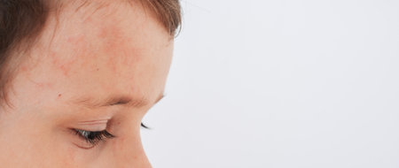 Close-up of the face of a child infected with the Coxsackie virus. Spots, Blisters and a rash on the boys face.の写真素材