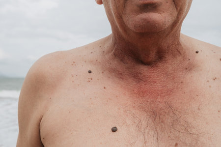 keratinizing squamous cell carcinoma of the skin of an elderly manの写真素材
