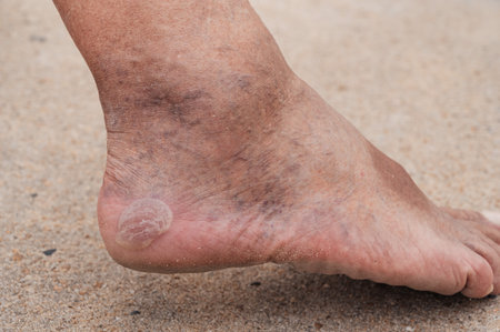 Bare male feet with a large callus on the heel and venous dilatation of veins.の写真素材