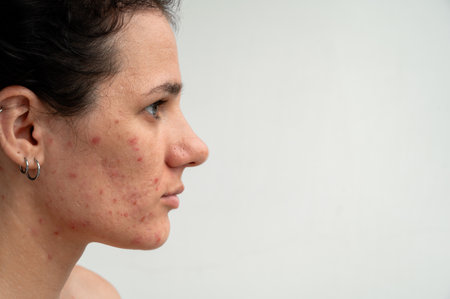 Close-up skin texture with red pimples, irritation and clogged pores, which indicates dermatological...