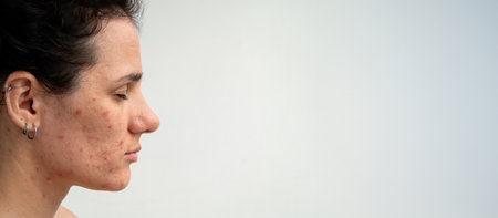 Close-up portrait of a young Caucasian woman with skin problems - pimples, acne, enlarged pores. A...