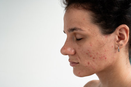 Close-up skin texture with red pimples, irritation and clogged pores, which indicates dermatological problems with skin care. Hormonal acne and spots on the face.の写真素材