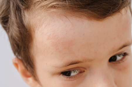 The Coxsackie virus. Symptoms on childrens facial skin. Painful rash, red spots, blisters.の写真素材