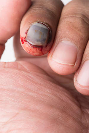 close up broken nail on white backgroundの写真素材