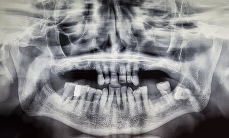 Orthopantomography of an adult patient, dentistry